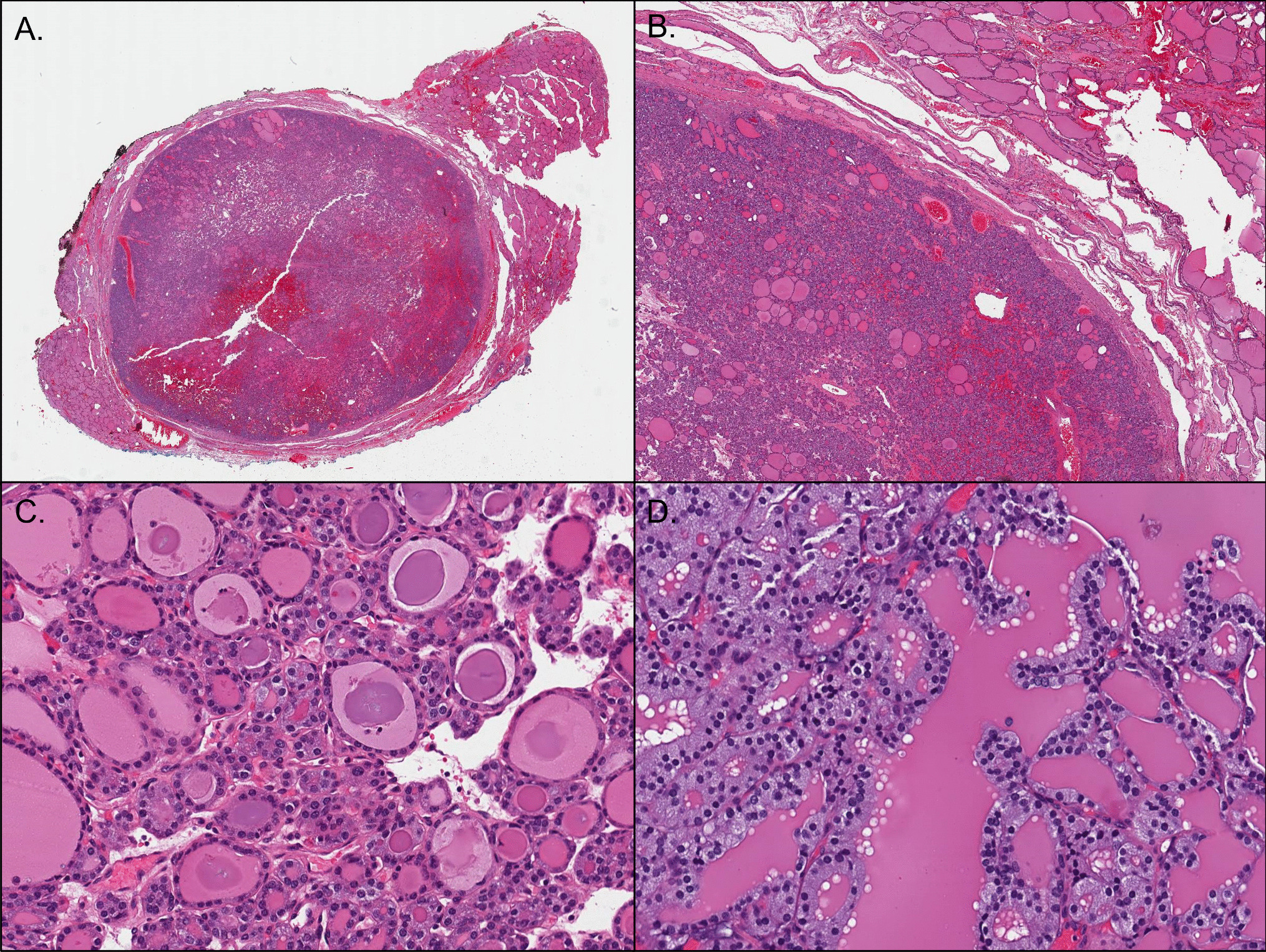 RAS-Mutant Follicular Thyroid Tumors: A Continuous Challenge for Pathologists