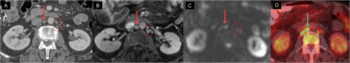 Whole-body magnetic resonance imaging for staging patients with high-risk prostate cancer