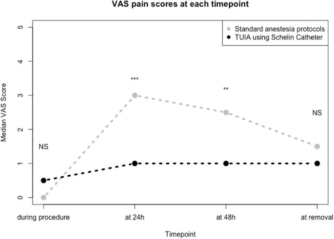 Use of a Schelin catheter for transurethral intraprostatic anesthesia (TUIA) prior to iTIND procedure