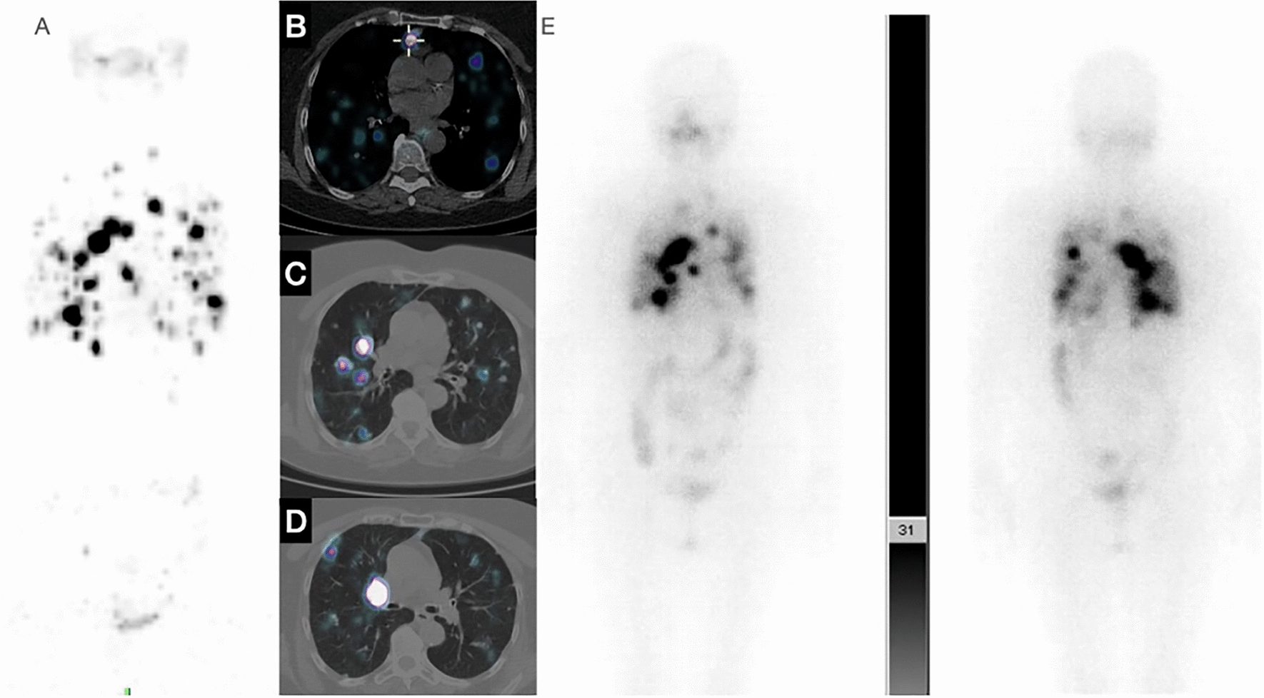 Endocrinology application of molecular imaging: current role of PET/CT