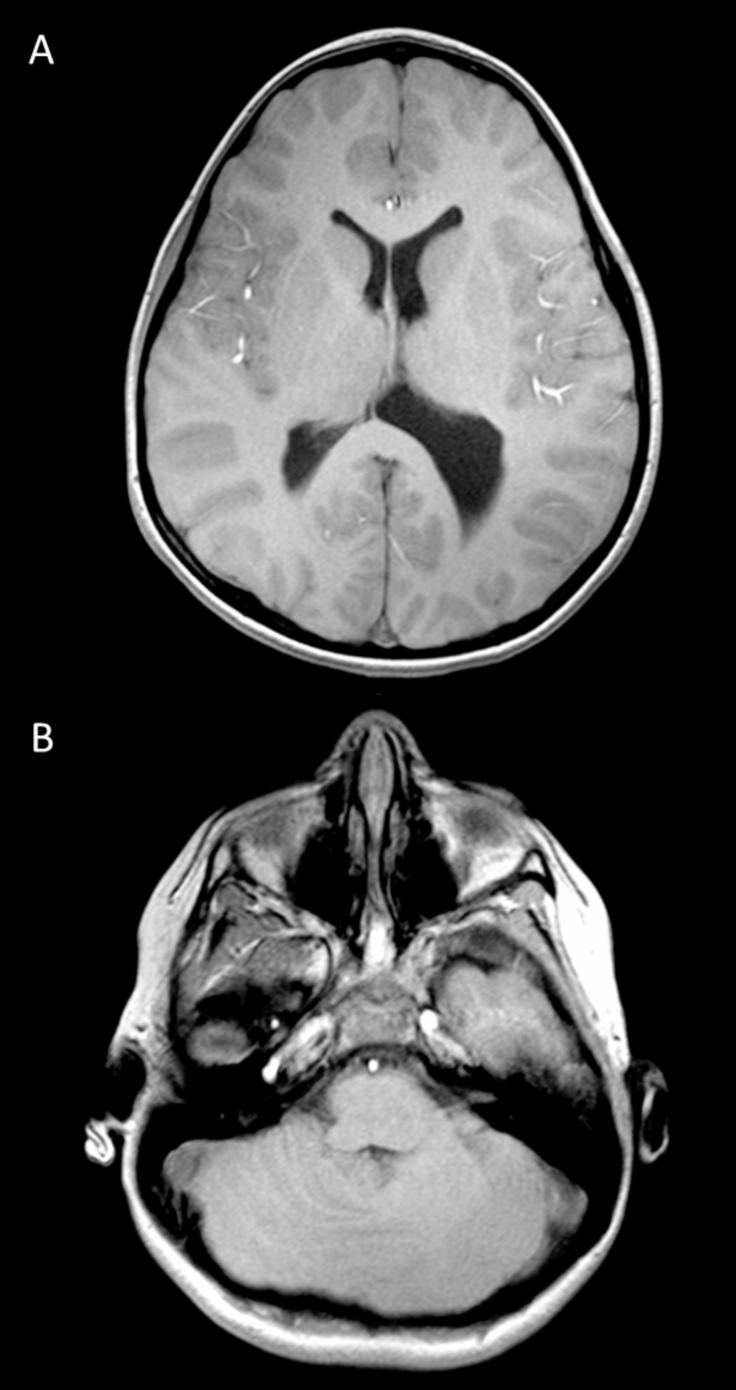 Neuropsychiatric Symptoms in Rhombencephalosynapsis: A Clinical Report