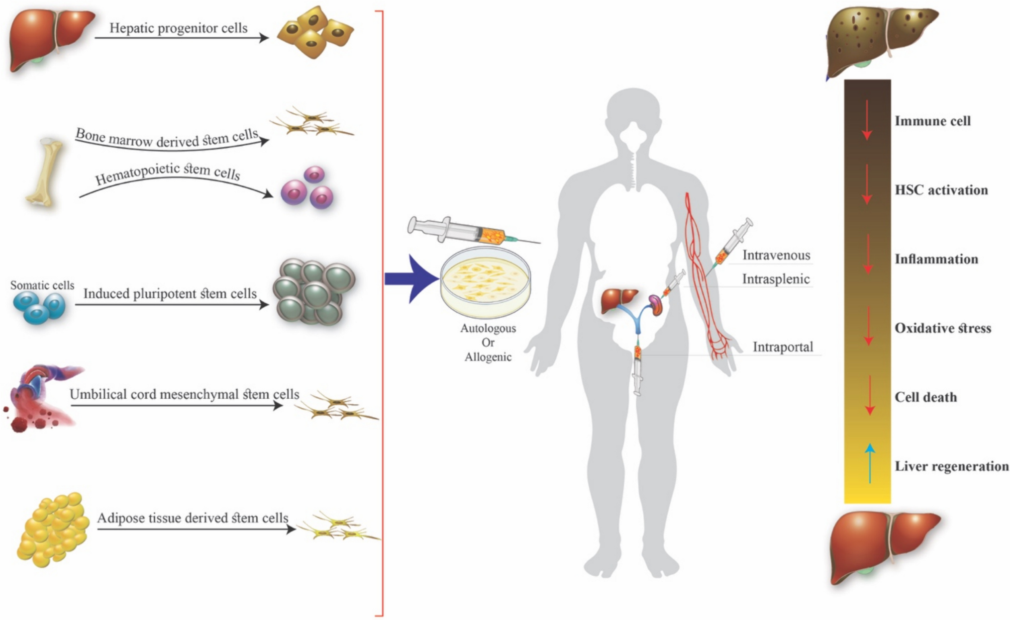 Stem Cell Therapy as a Potential Treatment of Non-Alcoholic Steatohepatitis-Related End-Stage Liver Disease: A Narrative Review