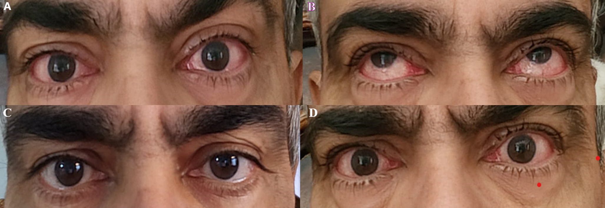 Lenalidomide Induced Conjunctivitis in a Patient with Multiple Myeloma