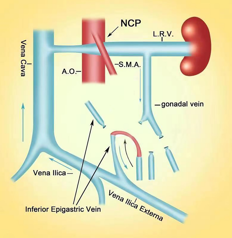 Microscopic internal spermatic-inferior epigastric vein anastomosis for treating left varicocele