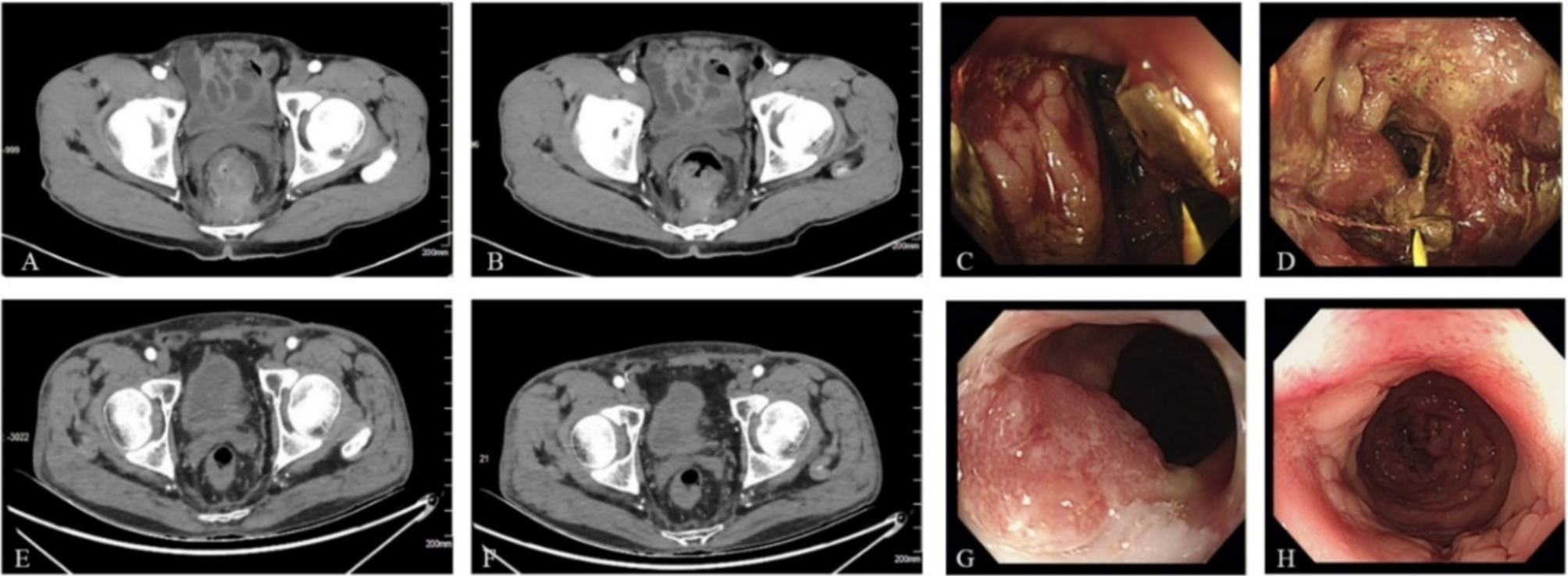 Case report: is necrotizing fasciitis in a rectal cancer patient after targeted systemic therapy related to the tumor site? - evidence from a hepatocellular carcinoma patient