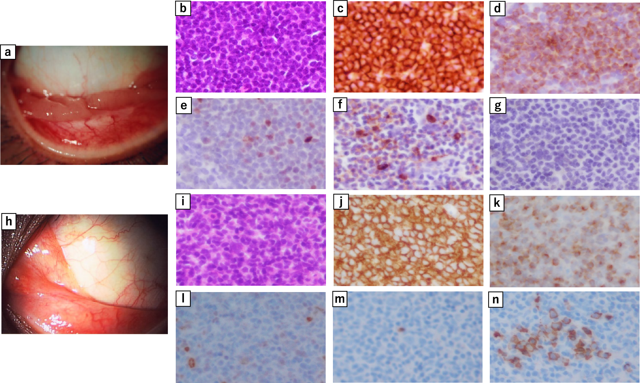 Bilateral development of biclonal ocular adnexal marginal zone lymphoma at a 2-year interval