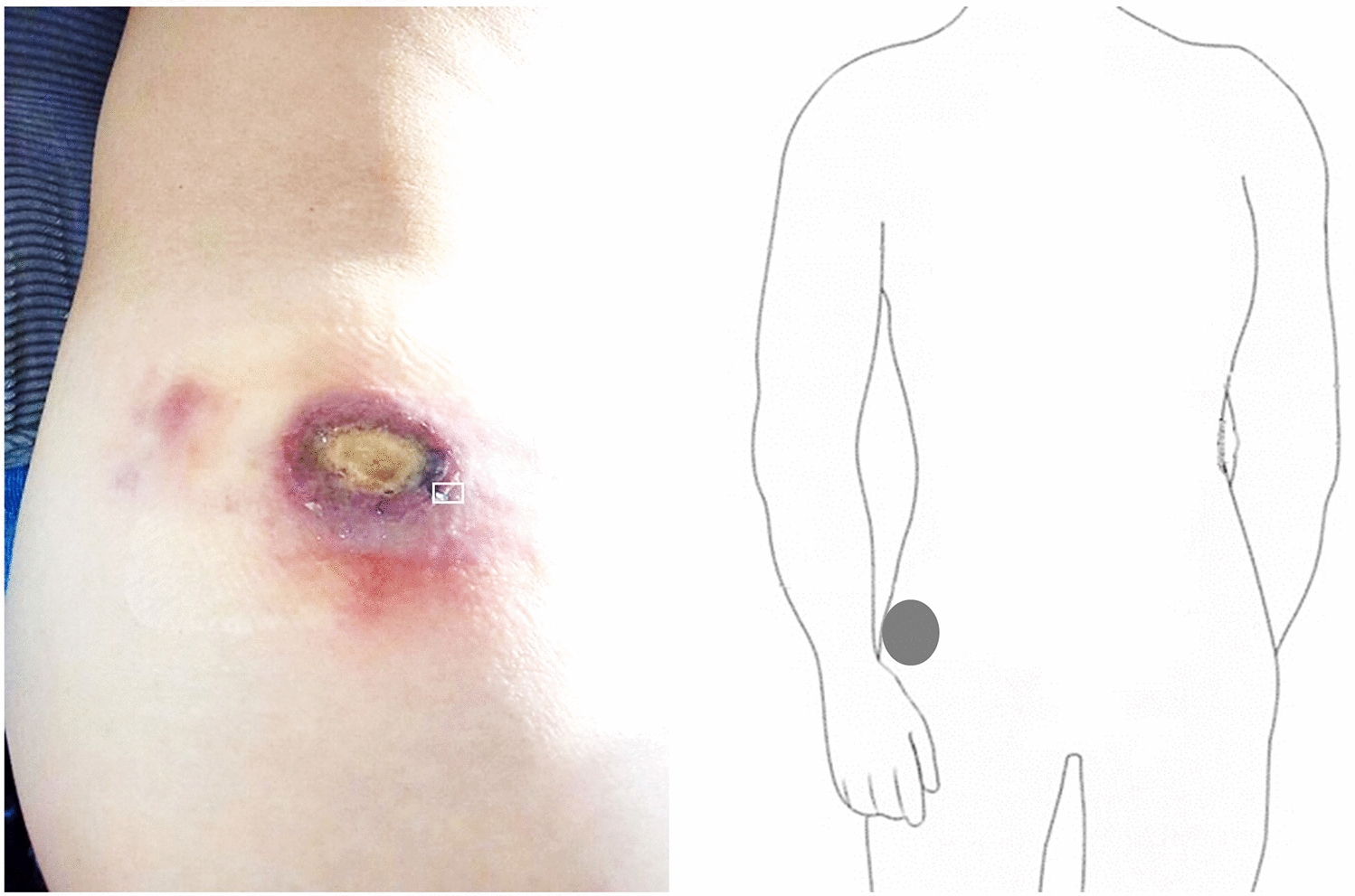 Pathological landscape of tumor flare reaction to epcoritamab treatment