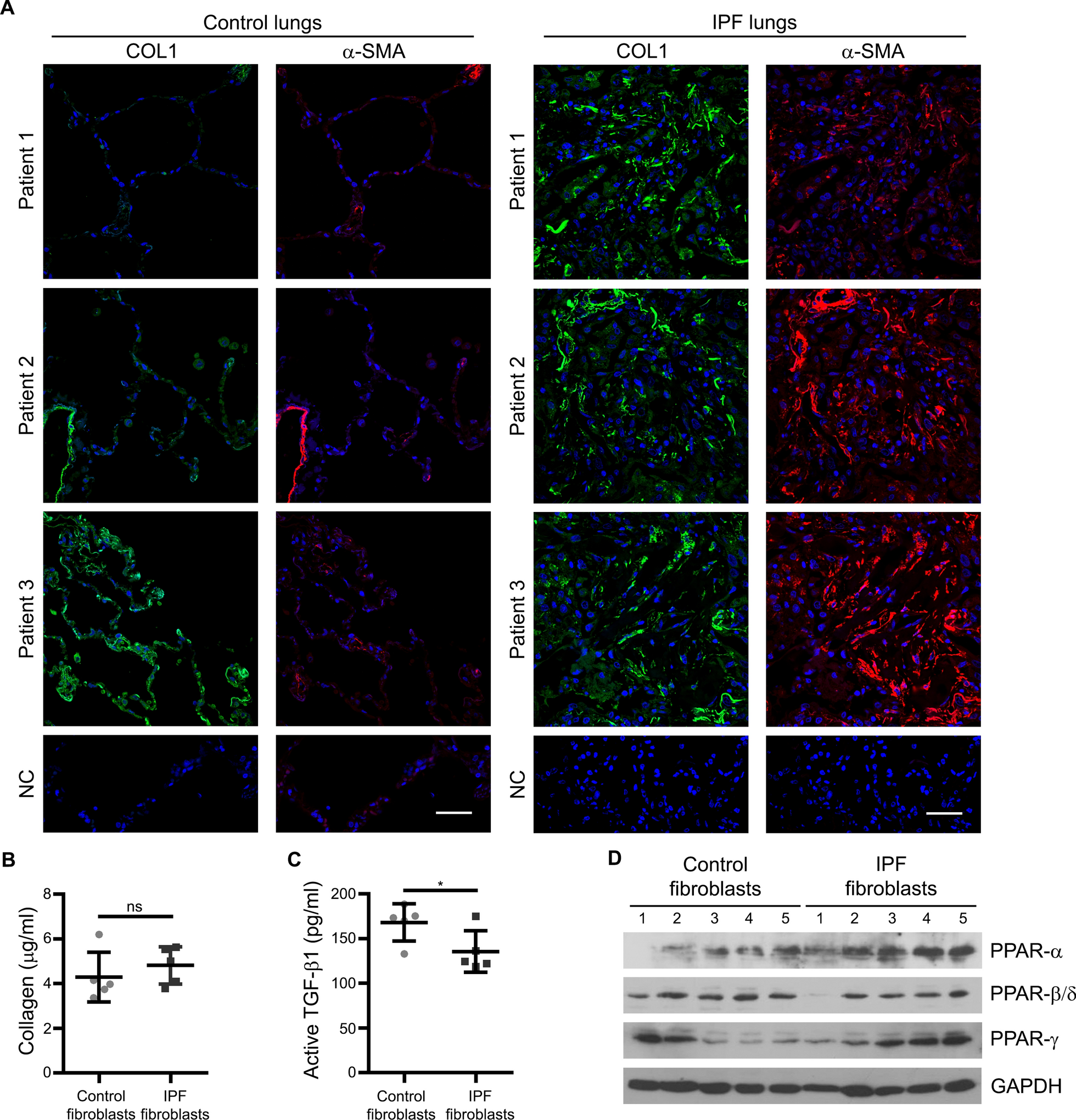 It takes two peroxisome proliferator-activated receptors (PPAR-β/δ and PPAR-γ) to tango idiopathic pulmonary fibrosis