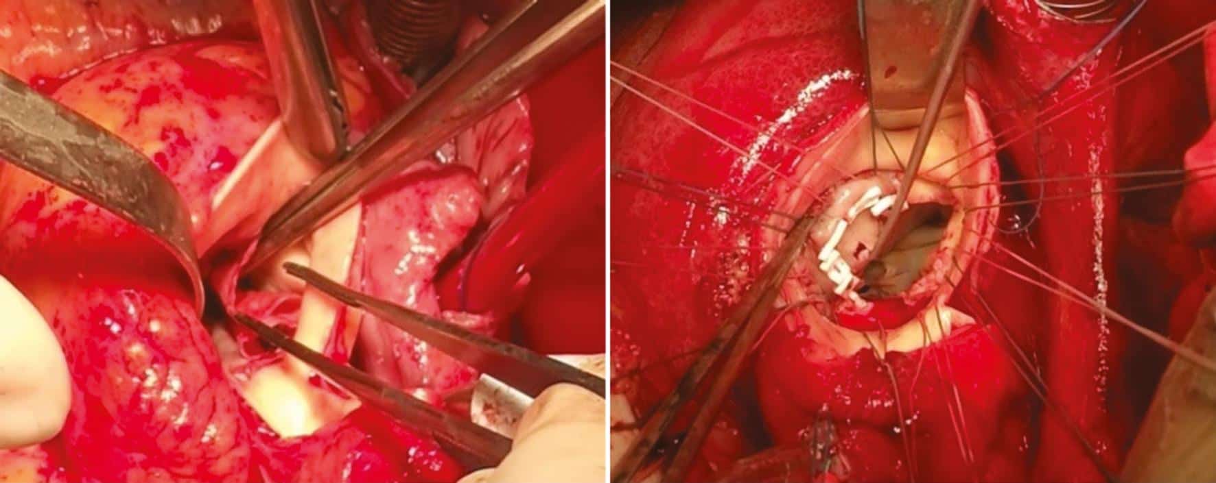 Surgical Treatment of Aortic Annulus Damaged by Infective Endocarditis: A Single-Center Experience