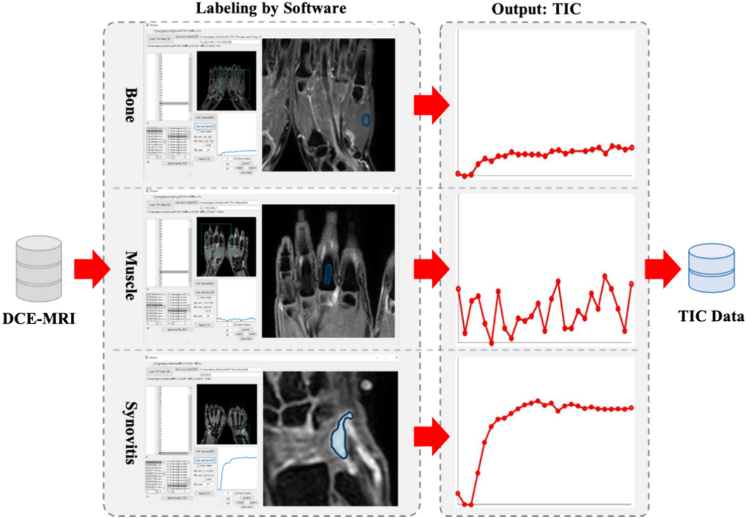 Fully automatic quantification for hand synovitis in rheumatoid arthritis using pixel-classification-based segmentation network in DCE-MRI