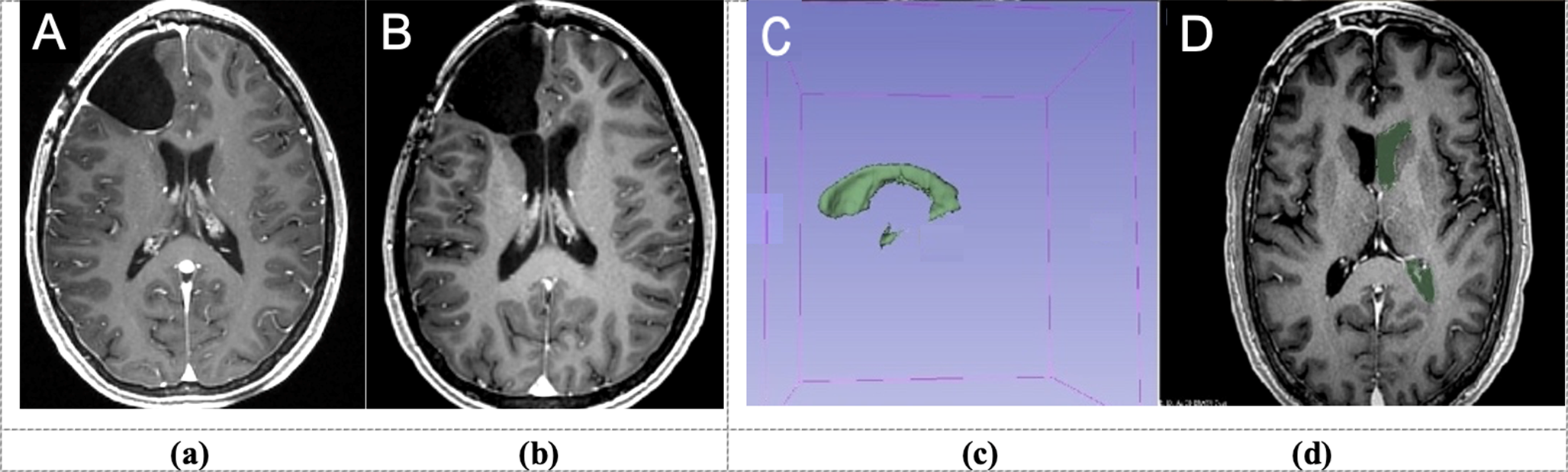 Brain volume loss after cranial irradiation: a controlled comparison study between photon vs proton radiotherapy for WHO grade 2–3 gliomas