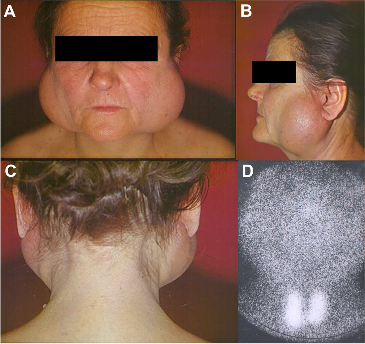 Clinical outcomes of NBF gel application in managing mucositis associated with xerostomia