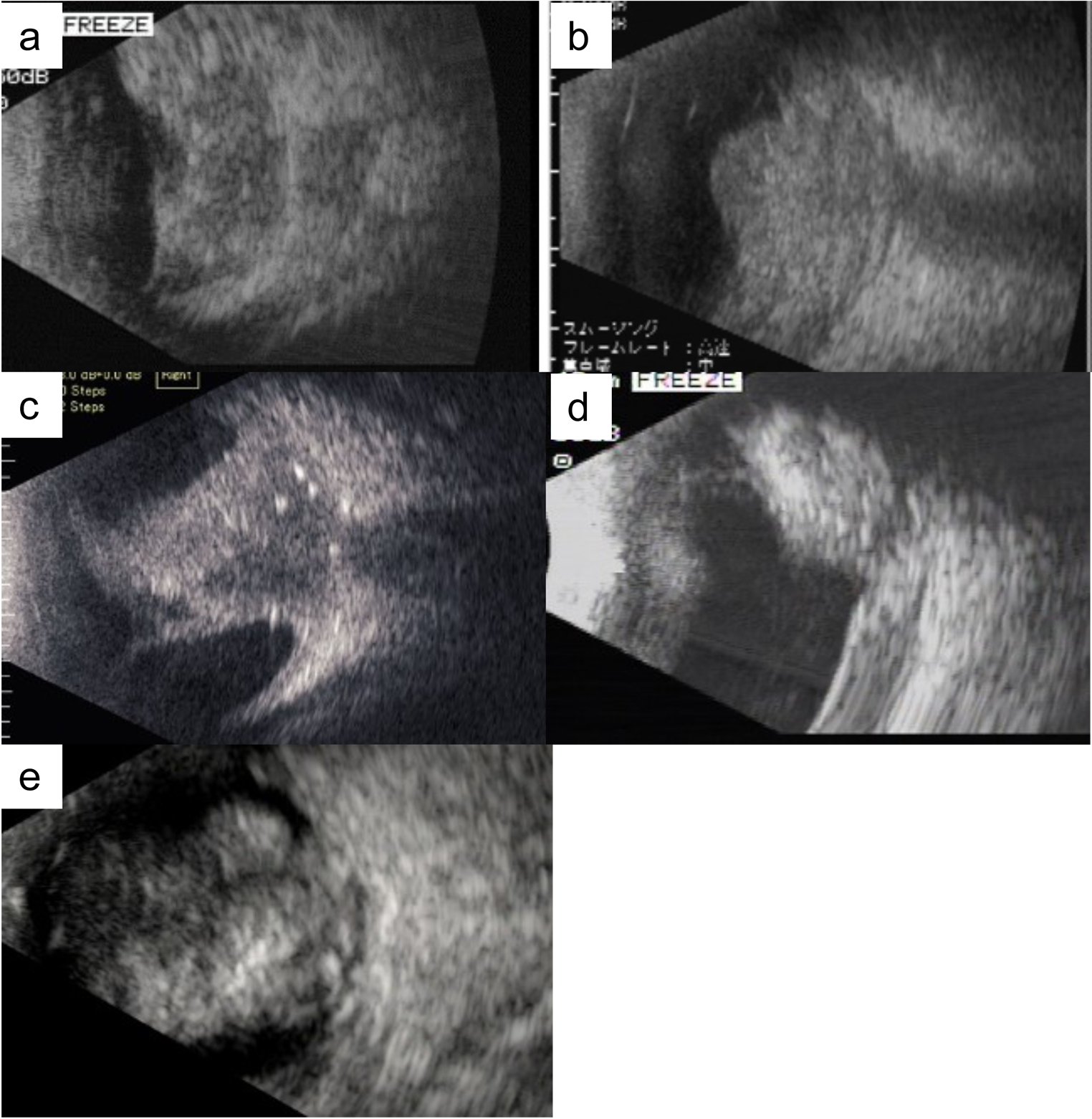 Outcomes of five cases of retinoblastoma with optic nerve invasion on imaging