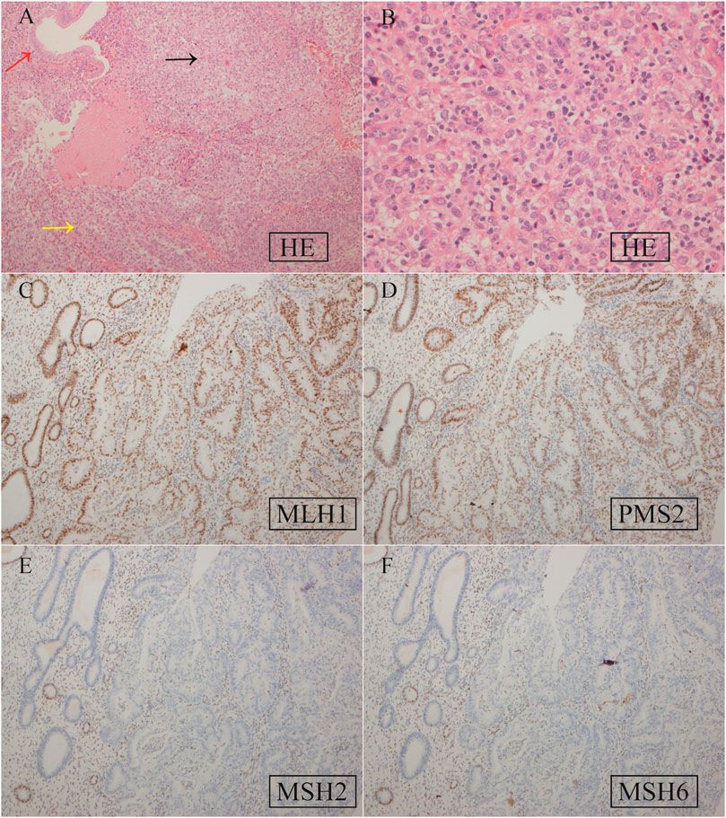 A new subtype of Lynch syndrome associated with MSH2 c.354T>A (p. Y118*) identified in a Chinese family: case report and literature review