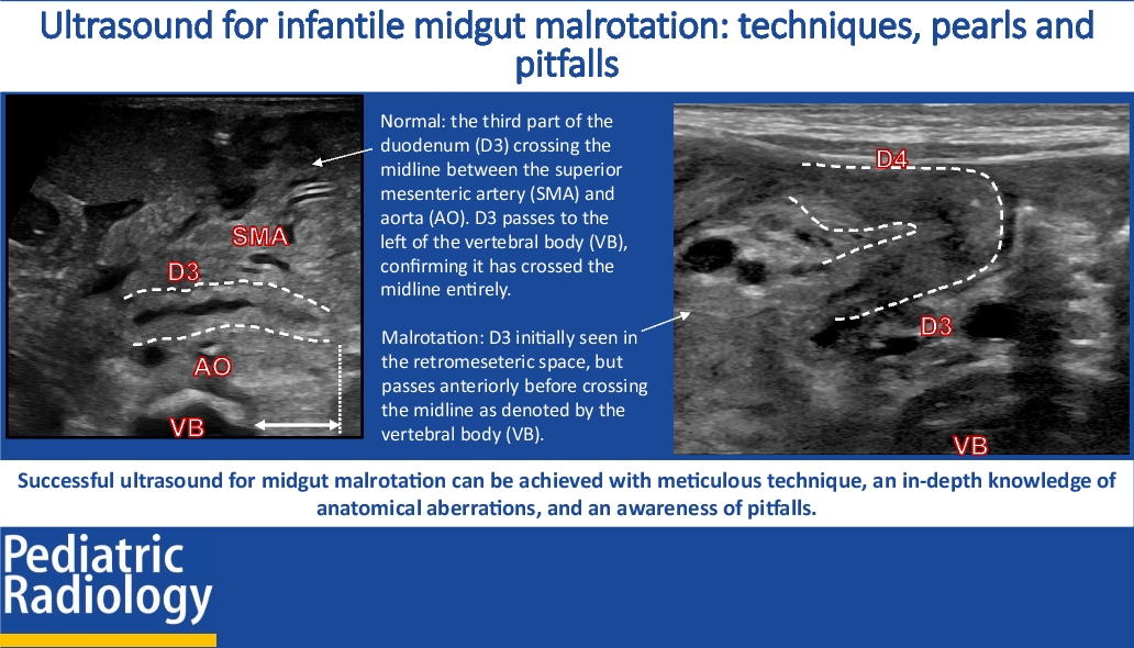 Ultrasound for infantile midgut malrotation: Techniques, pearls, and pitfalls