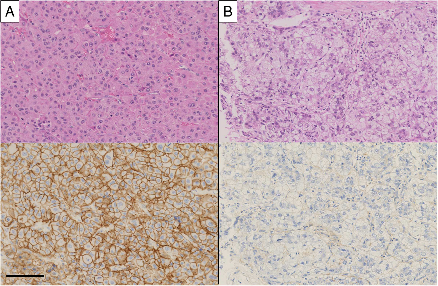 Relationships between tumor CD147 expression, tumor-infiltrating lymphocytes, and oncostatin M in hepatocellular carcinoma