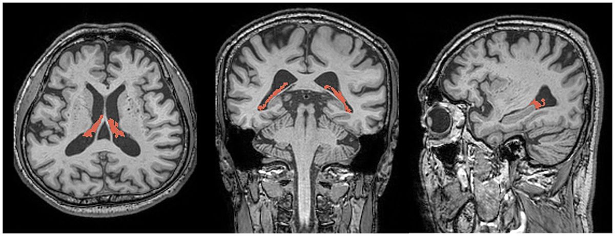 Choroid plexus enlargement in patients with end-stage renal disease: implications for glymphatic system dysfunction