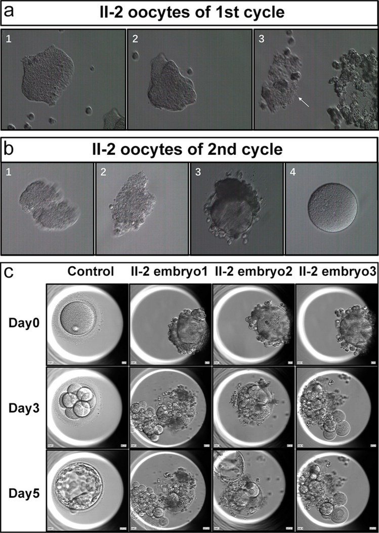 A Compound Heterozygous Pathogenic Variant in ZP2 Gene Causes Female Infertility