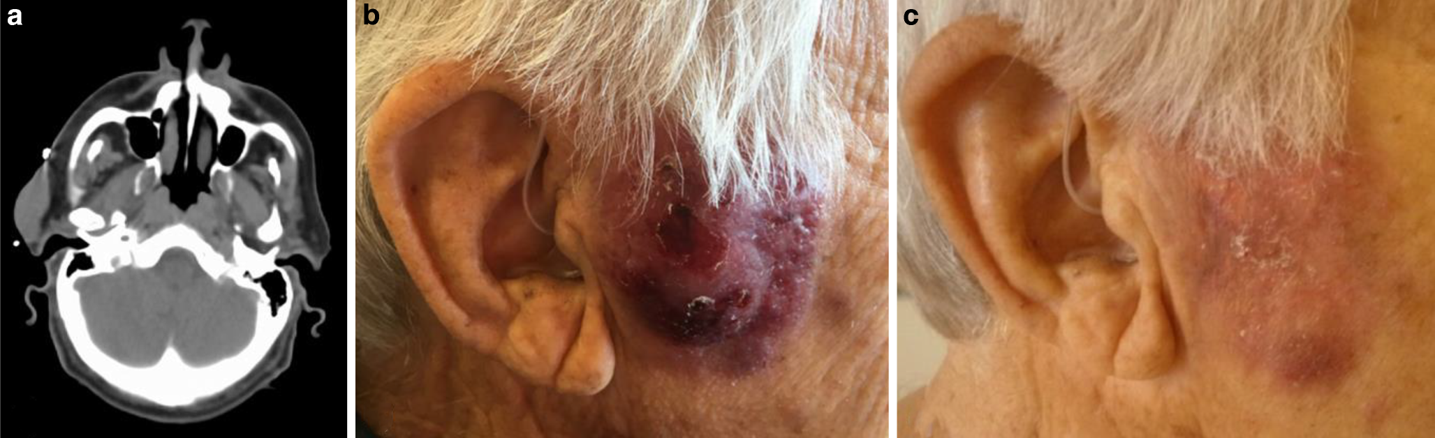 Ulcerating skin lesions from blastic plasmacytoid dendritic cell neoplasm responding to low-dose radiotherapy—a case report and literature review