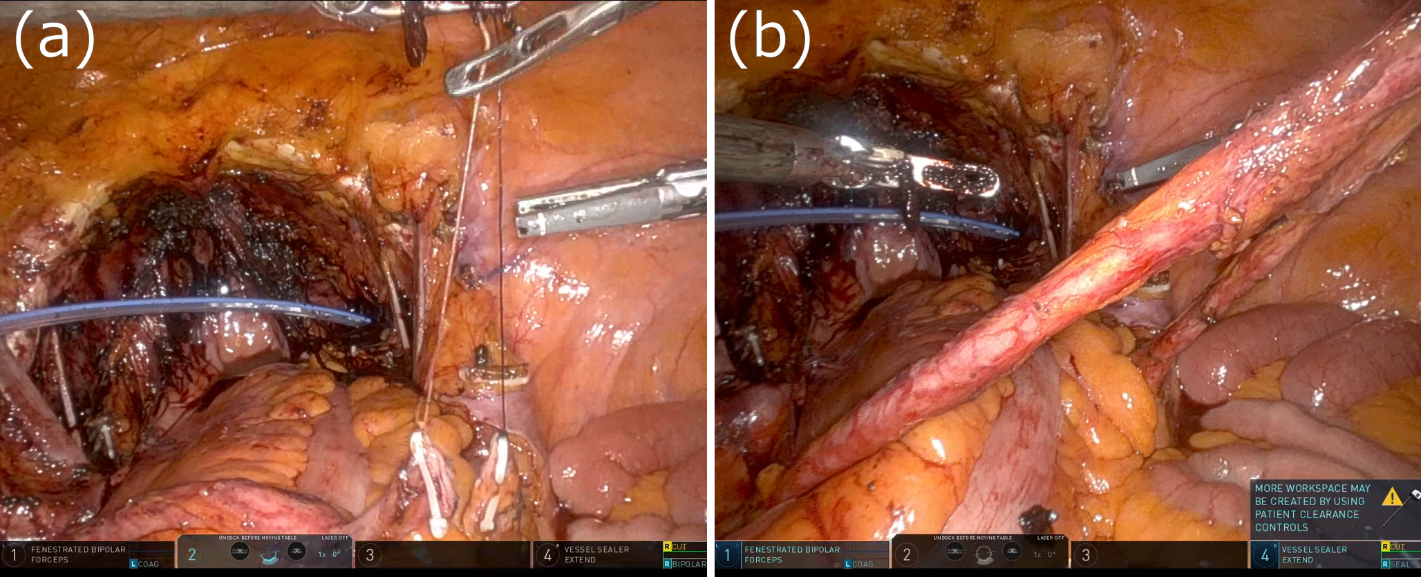 Cutaneous ureterostomy following robot-assisted radical cystectomy: a multicenter comparative study of transperitoneal versus retroperitoneal techniques