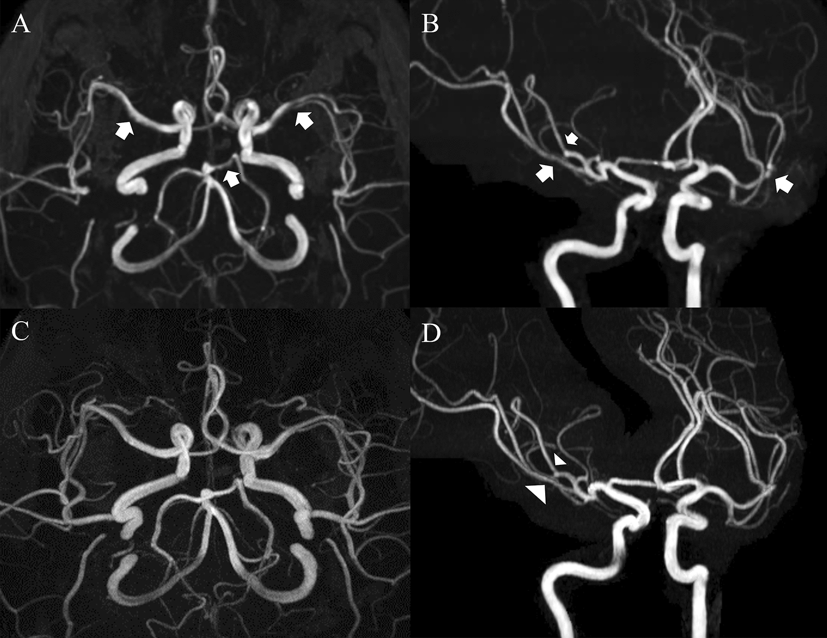 Cerebral Artery Vasoconstriction After Galcanezumab Loading Dose for Migraine Prevention: A Case Report