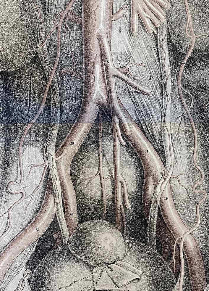 Normal, accessory, and aberrant branches of the common iliac artery: angiographic prevalence and clinical implications