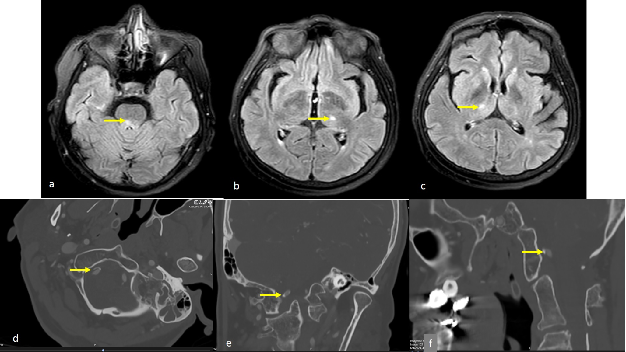 A large vertebral artery fenestration involving the distal segments associated with bilateral duplication of the superior cerebellar artery: a case report