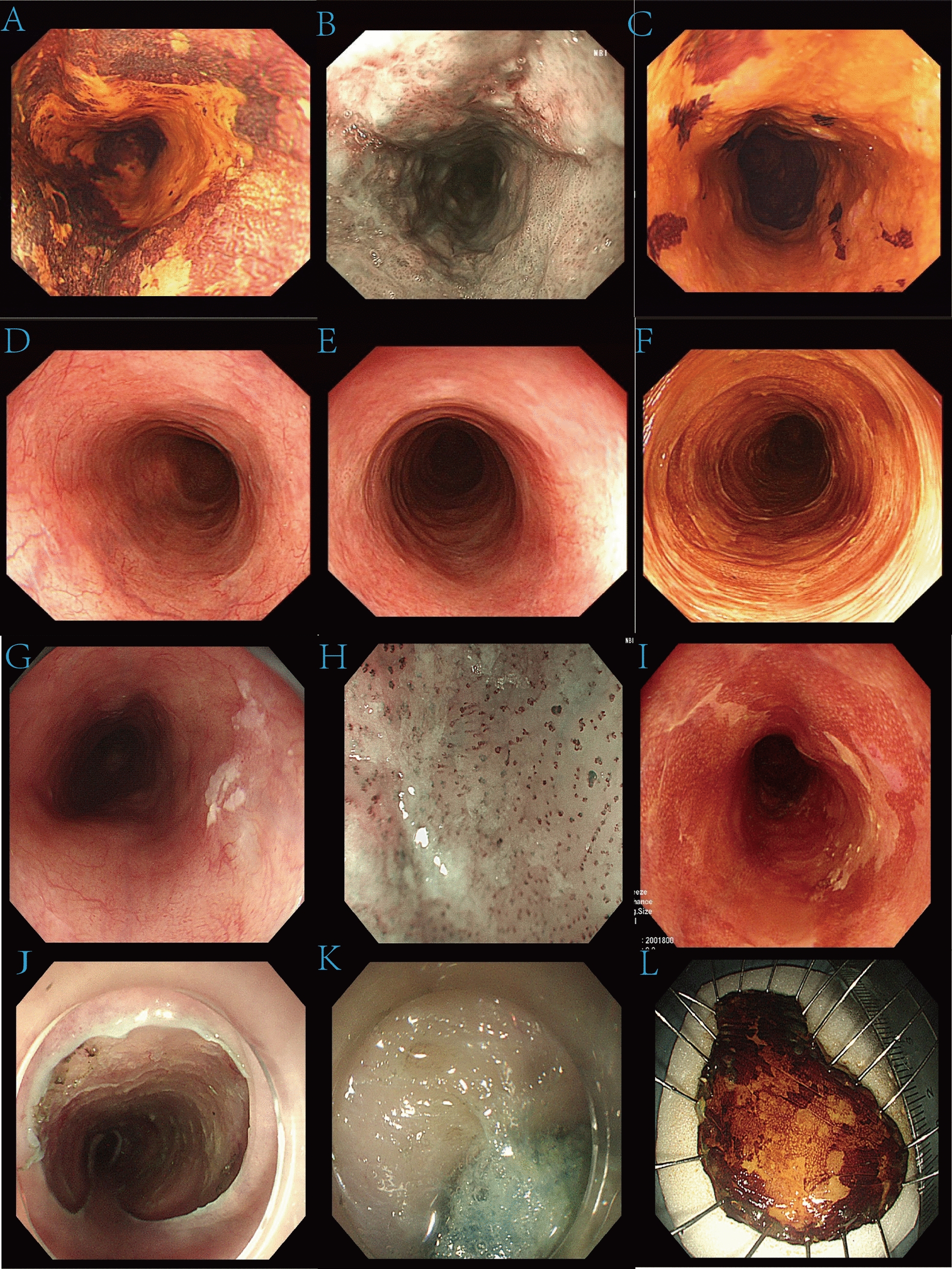 Retrospective study on endoscopic treatment of recurrent esophageal cancer patients after radiotherapy