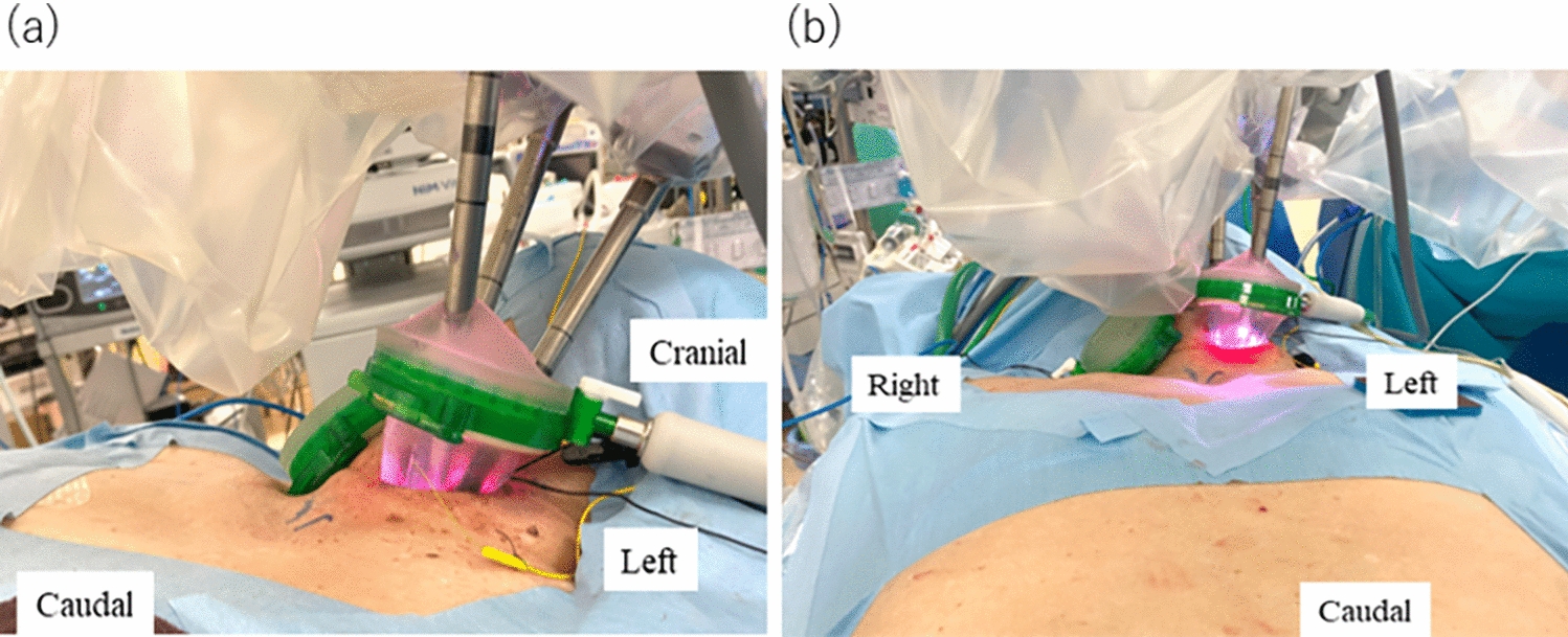 Robot-assisted cervical esophagectomy with simultaneous transhiatal abdominal procedure for thoracic esophageal carcinoma