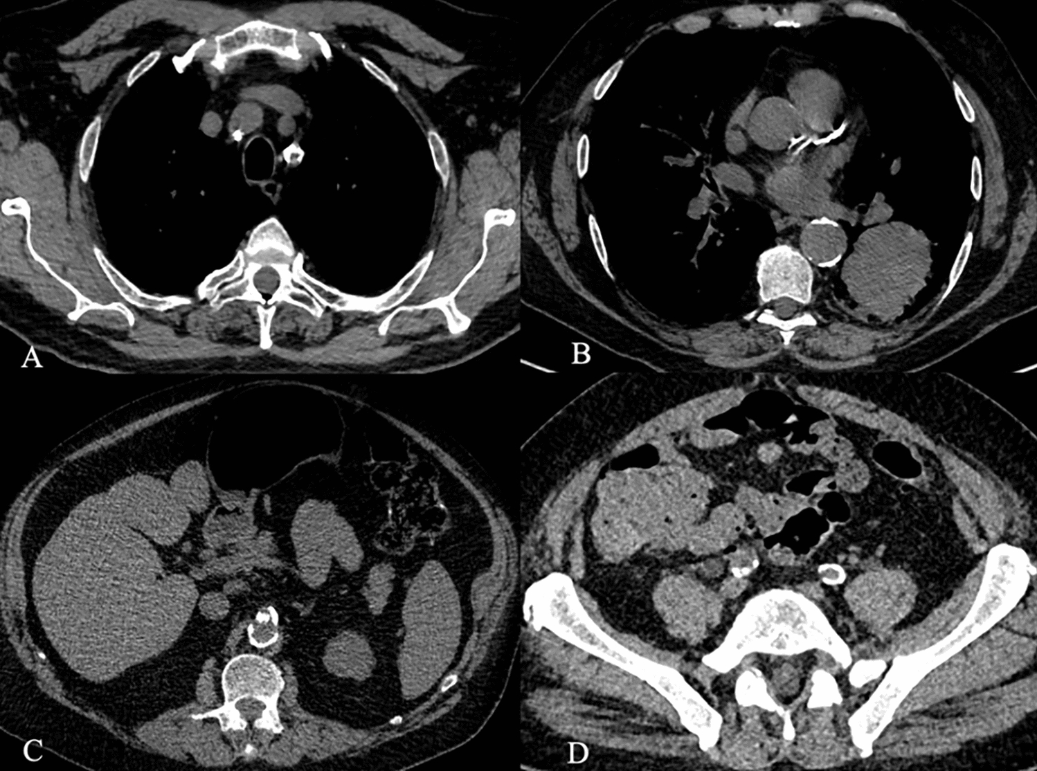 Major coronary artery calcifications as predictors of postoperative complications in Ivor Lewis esophagectomies: a five-year retrospective analysis