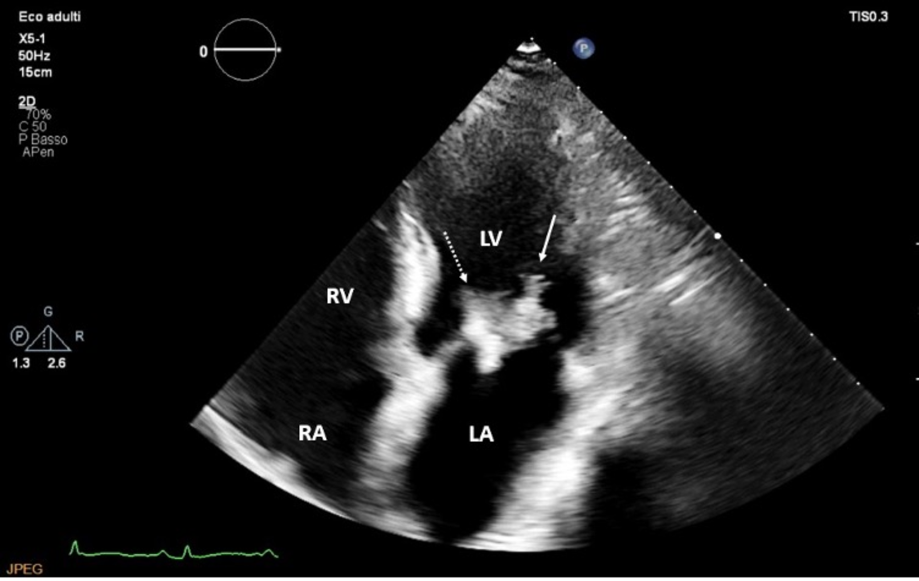 Chronic infection and severe mitral regurgitation: first of all, do not harm