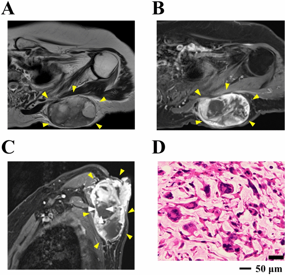 Establishment and characterization of two novel patient-derived cell lines from myxofibrosarcoma: NCC-MFS7-C1 and NCC-MFS8-C1