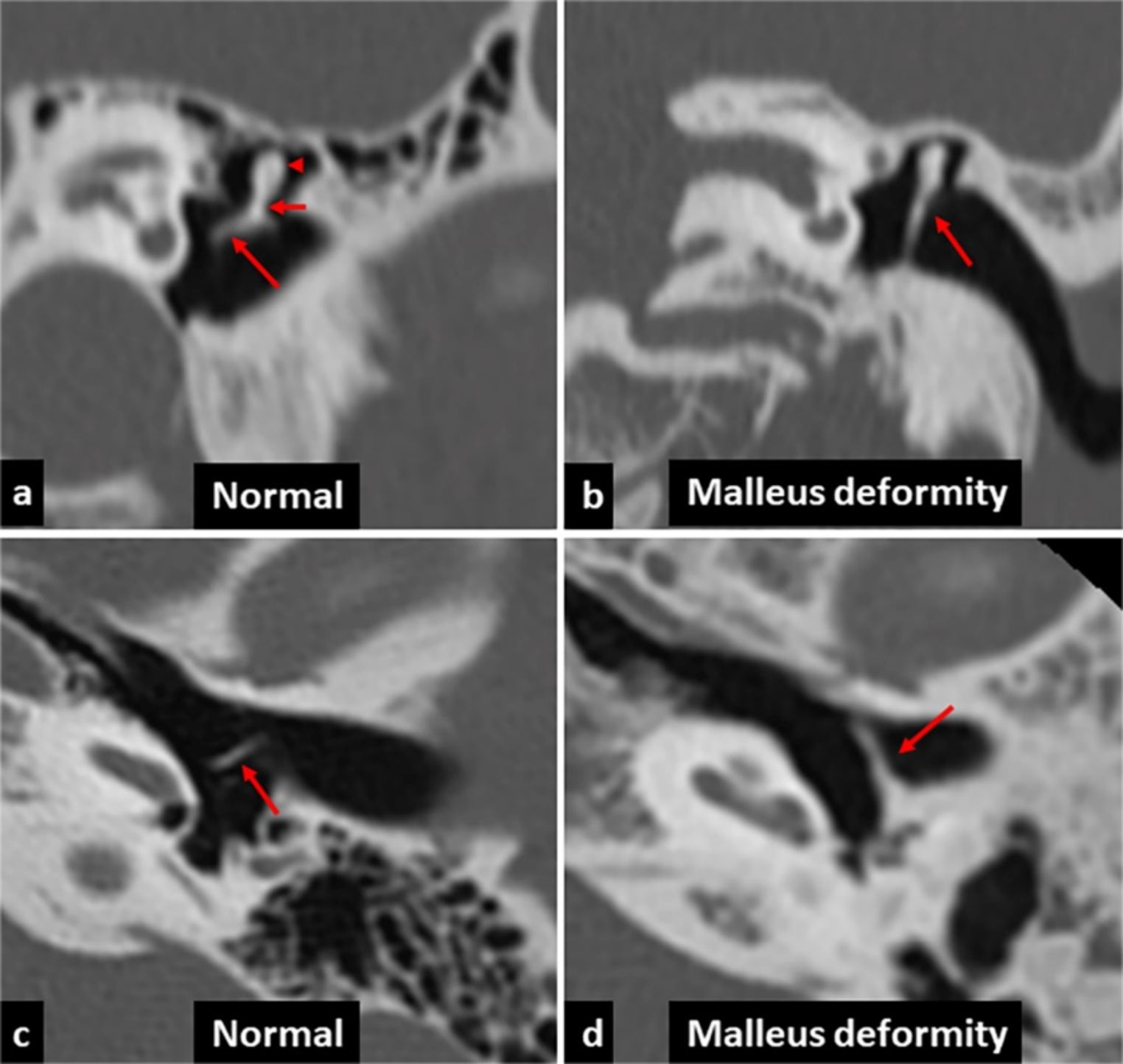 Imaging findings of isolated congenital middle ear malformation on high-resolution computed tomography