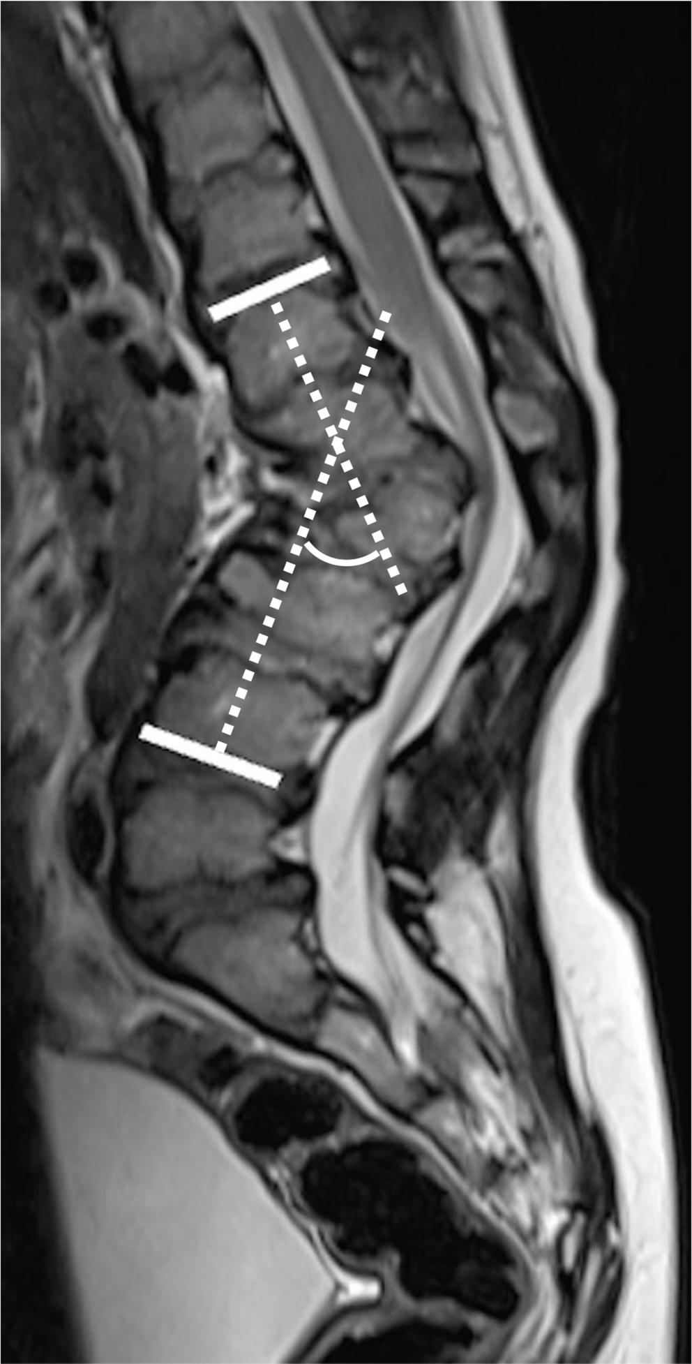 Prevalence and natural history of gibbus deformity in patients with Hurler syndrome