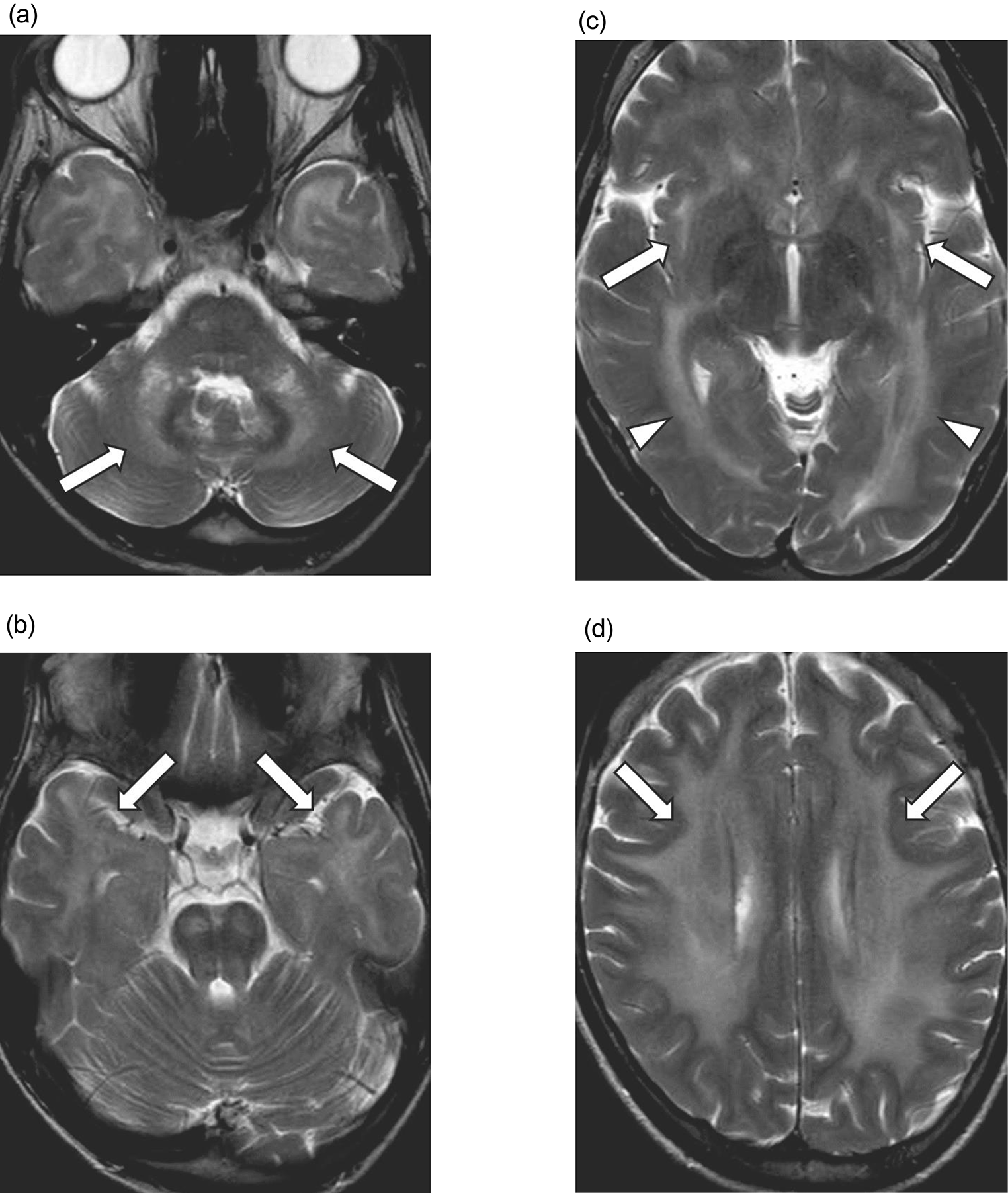 Neuromyelitis optica spectrum disorder mimicking cerebral autosomal dominant arteriopathy with subcortical infarcts and leukoencephalopathy with symmetrical lesions in the temporal poles and external capsules on MRI