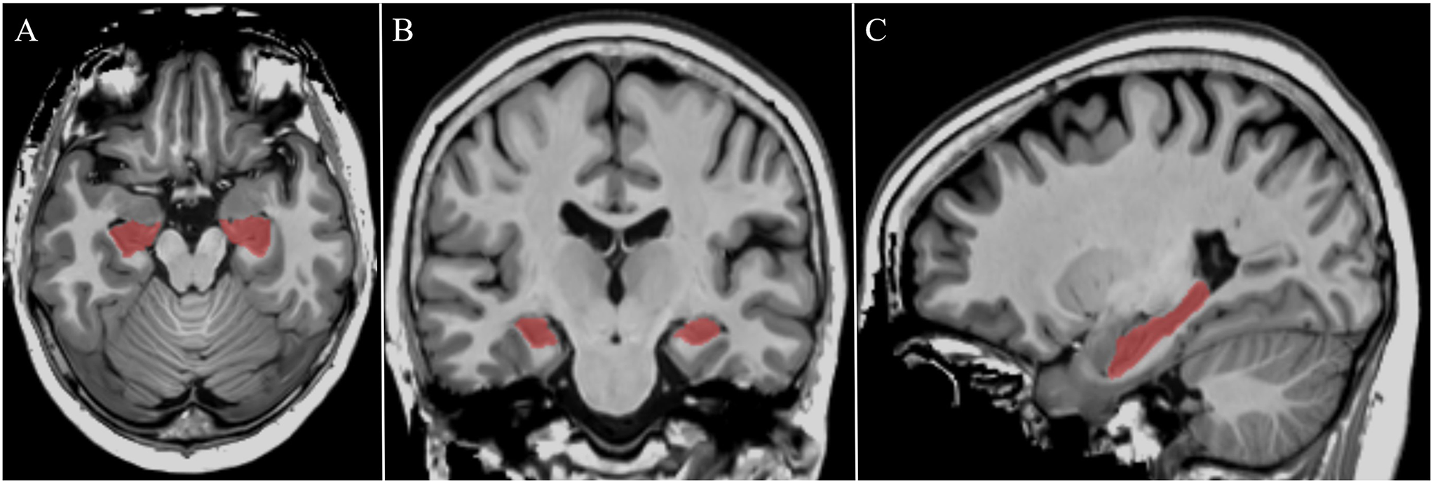 Hippocampus and olfactory impairment in Parkinson disease: a comparative exploratory combined volumetric/functional MRI study