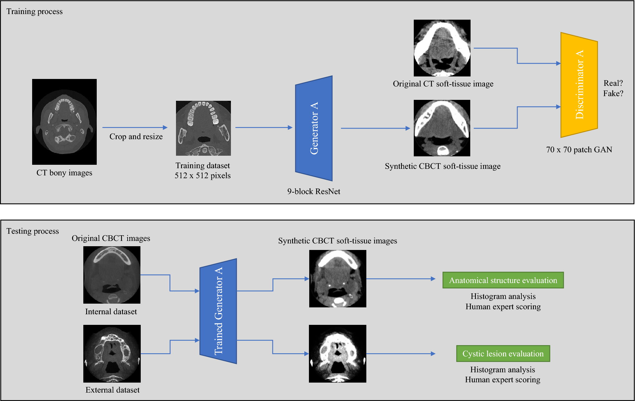 Improved soft-tissue visibility on cone-beam computed tomography with an image-generating artificial intelligence model using a cyclic generative adversarial network