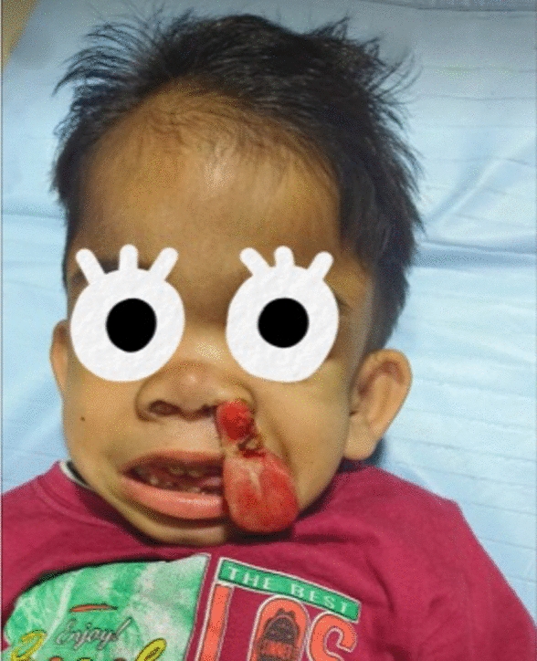 Miller’s Syndrome with Bleeding Nasal Polyp