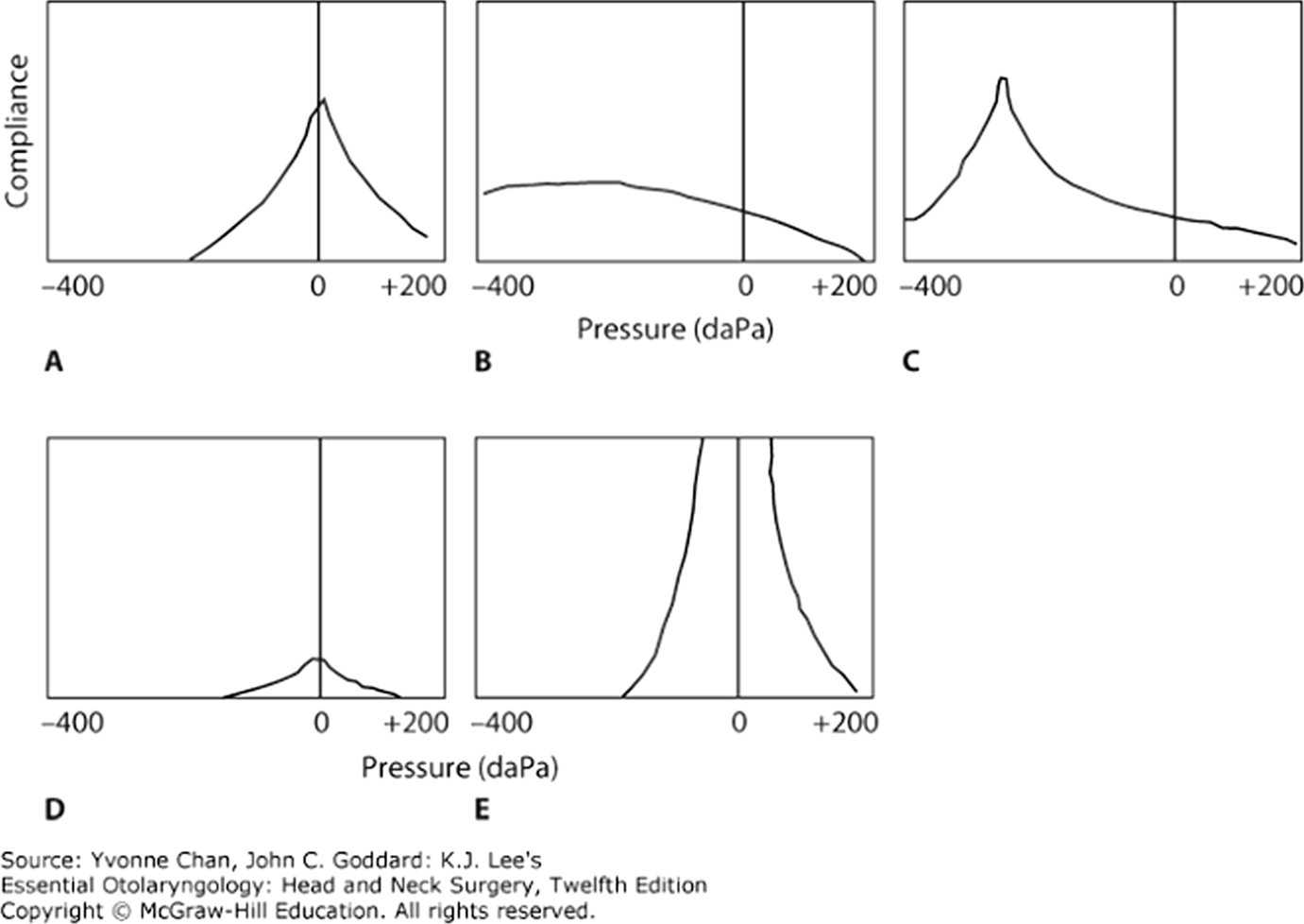 Typmpanometric Findings Pre and Post Adenoidectomy Amongst Children with Obstructive Adenoid Enlargement