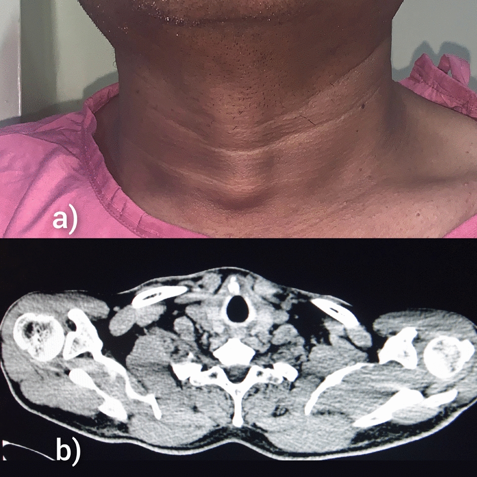 Papillary Carcinoma in Thyroglossal Cyst: A Case Report with Comprehensive Review of Treatment Modalities