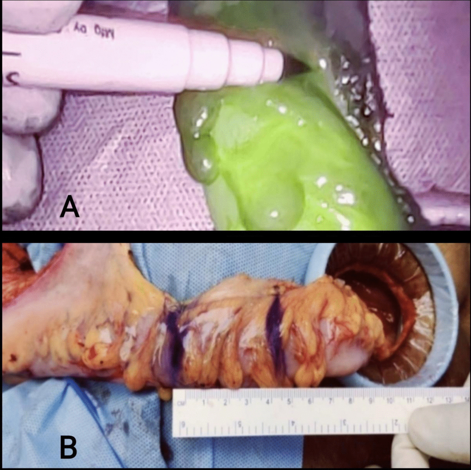 Role of Indocyanine Green Angiography to Assess Intra-operative Bowel Vascularity and its Association with Post-operative Outcome in Robot-assisted Rectal Resection: a Prospective Indian Cohort Study