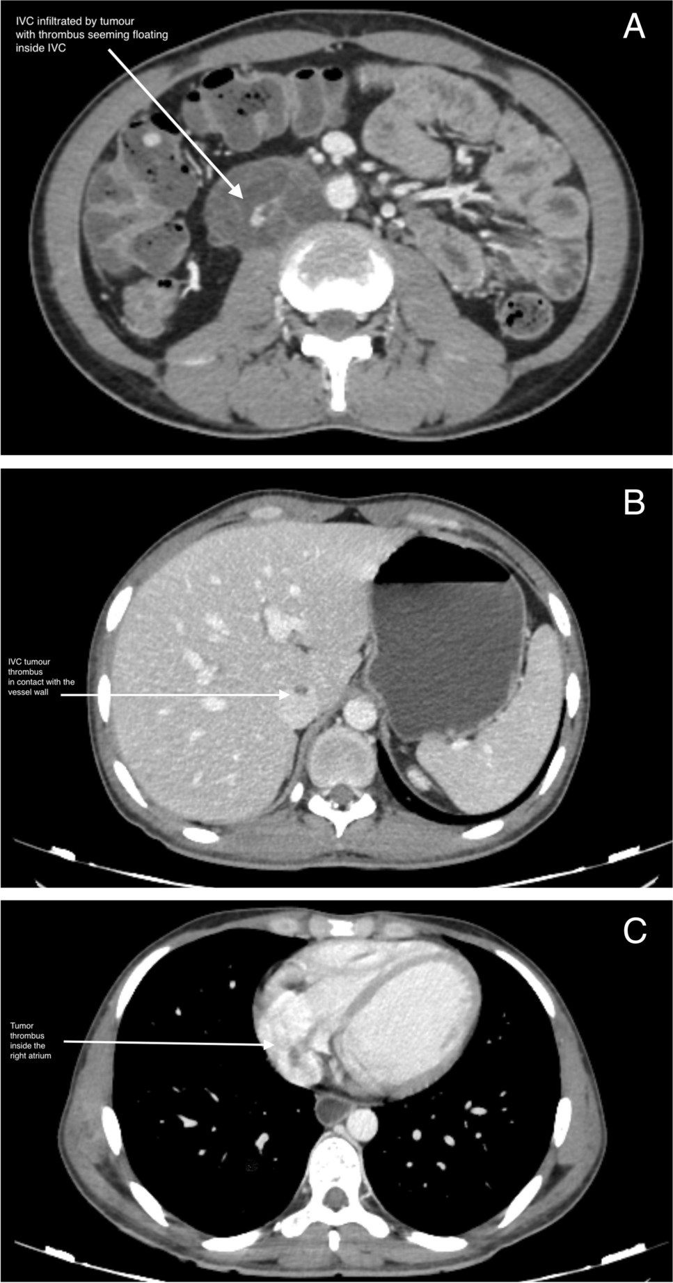 Between the Devil and the Deep Sea—The Cardiac Conundrum: Report of a Contiguous Cavo-Atrial Tumor Thrombus in NSGCT Testis