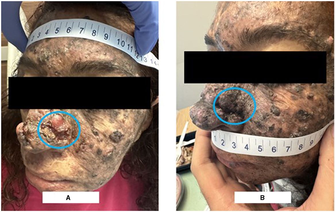 Case report: Neoadjuvant-intent pembrolizumab resulted in complete response in a xeroderma pigmentosum patient with locally advanced resectable cutaneous squamous cell carcinoma of the nose