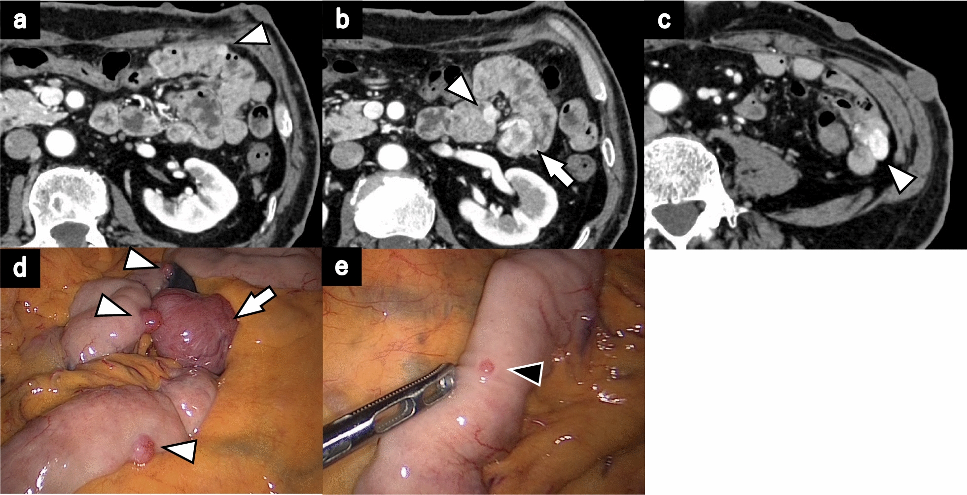 Appendiceal neurofibroma after resection of multiple gastrointestinal stromal tumors of the small intestine in a patient with neurofibromatosis type 1: a case report