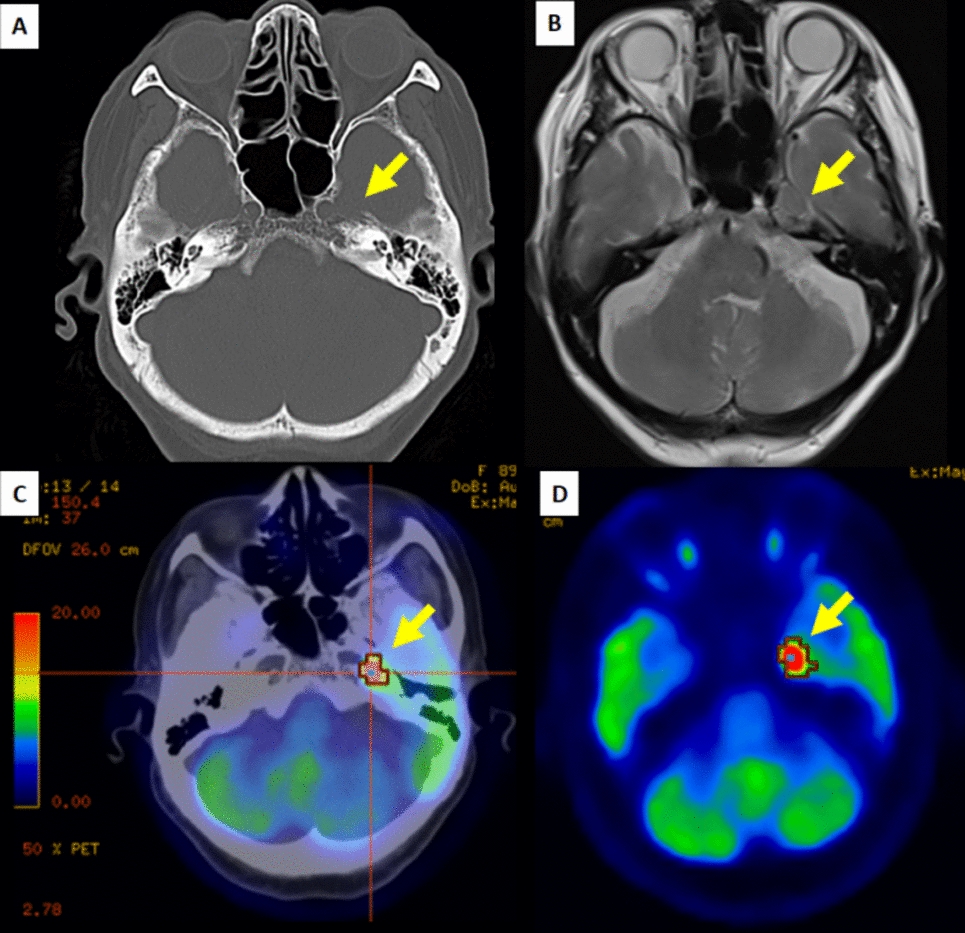 Successful osimertinib treatment for Meckel’s cave metastasis: a case report