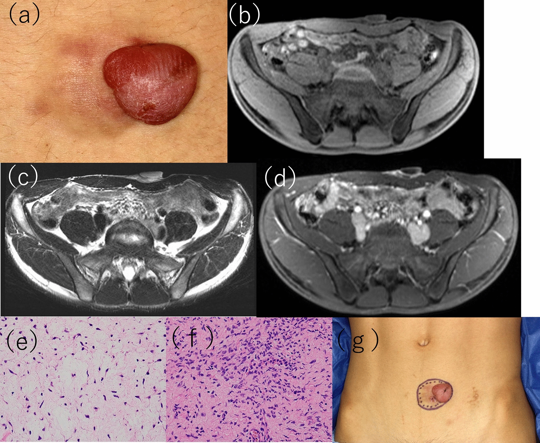 Dermatofibrosarcoma protuberance with a unique appearance mimicking neurofibroma arising from a conventional area