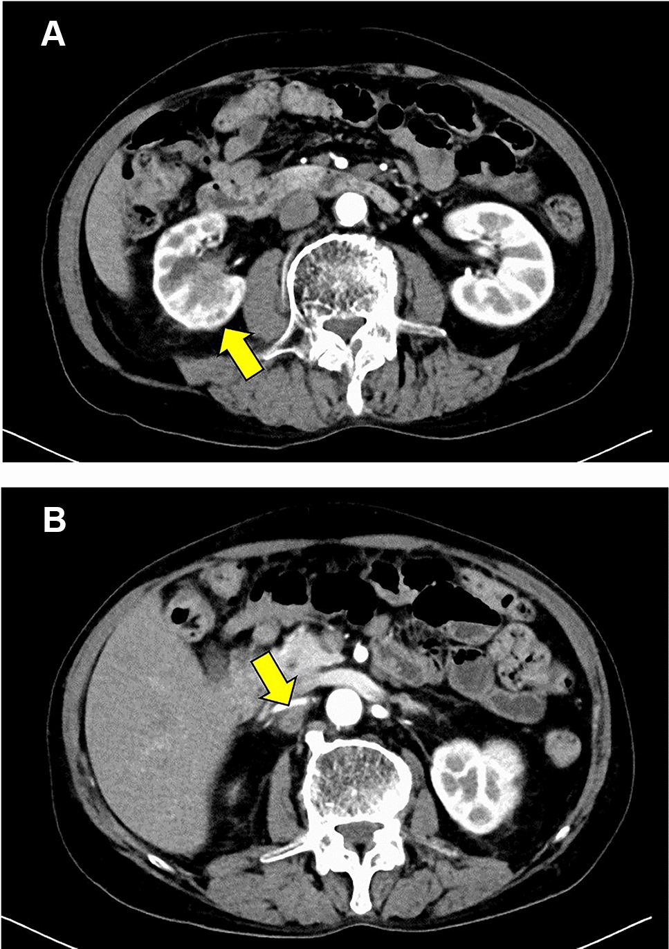 A pathological complete response and adrenal insufficiency in a patient with advanced renal pelvic cancer treated with pembrolizumab