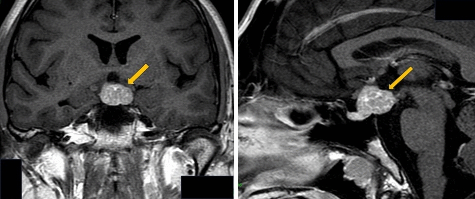 Fertility preservation in men with hypogonadotropic hypogonadism secondary to germinoma: two cases of gonadotropin replacement therapy before induction of anticancer chemotherapy