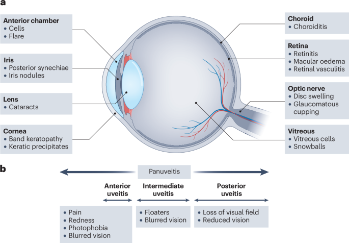 The management of adult and paediatric uveitis for rheumatologists