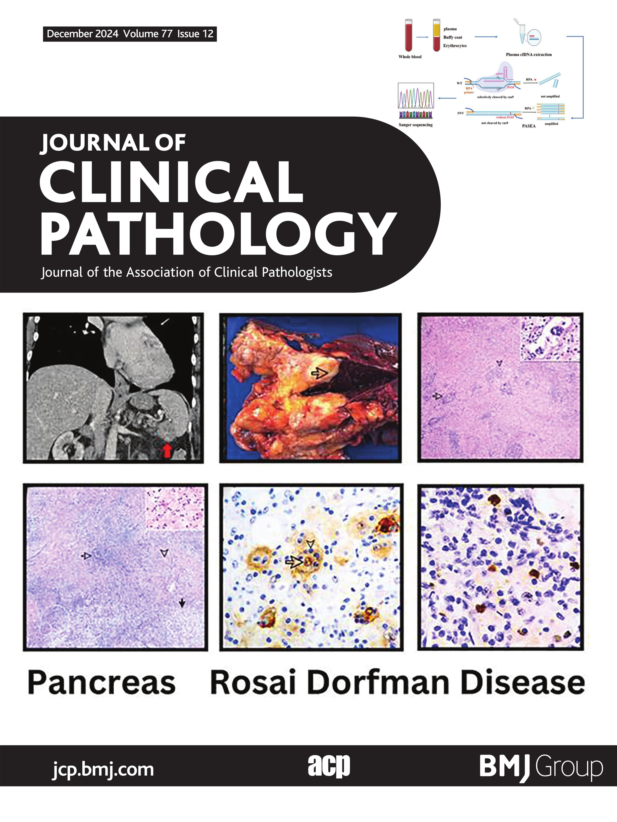 Rosai-Dorfman Disease of pancreas: rare aetiology mimicking malignancy